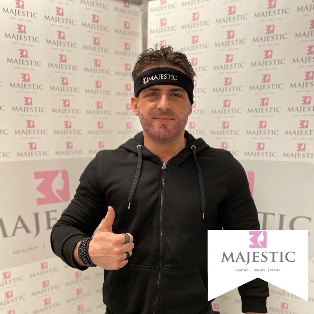 Resultados del trasplante de cabello fue