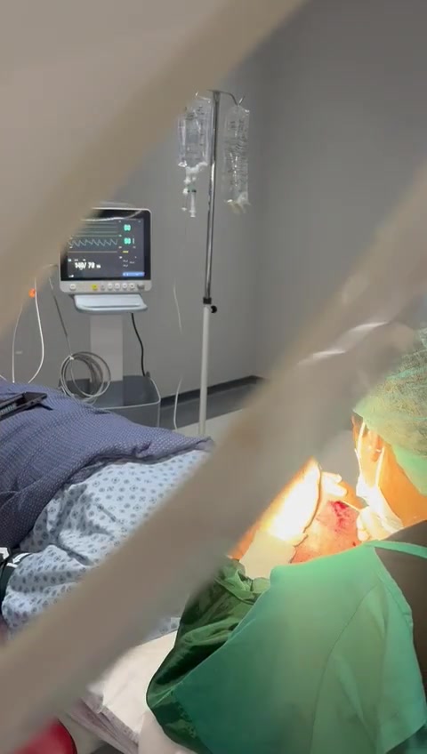 Procédure de greffe de barbe