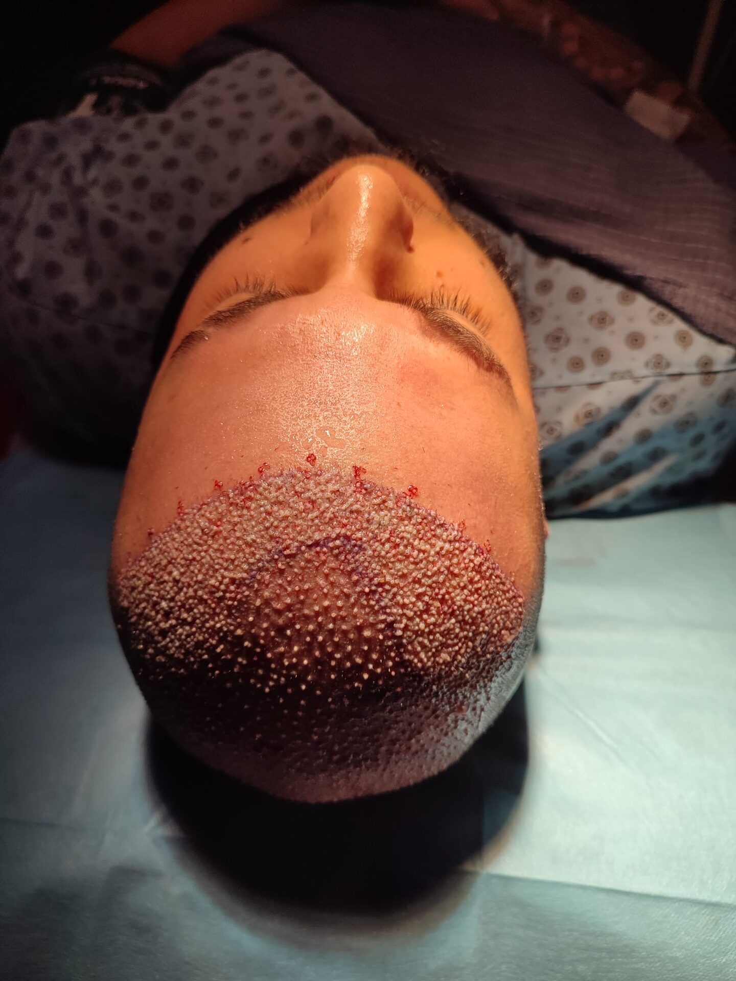 DHI Hair Transplant Result